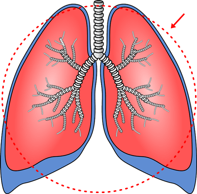 肺炎の特徴と対処