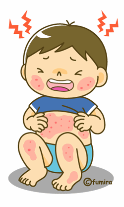 アトピー性皮膚炎の特徴と対処
