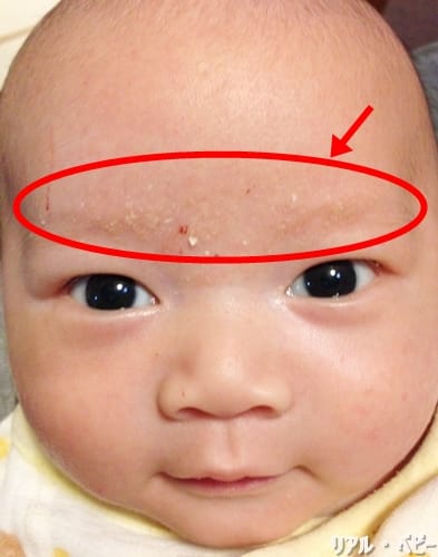 乳児湿疹 乳児脂漏性湿疹の特徴と対処