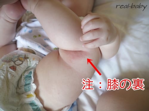 赤ちゃんのお肌トラブル対処！原因は外部？内部？