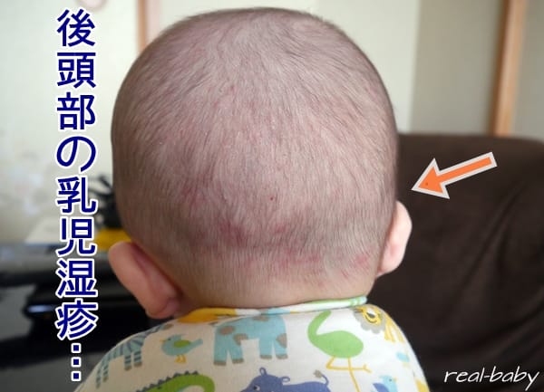 赤ちゃんの後頭部に乳児湿疹？夏の乳児湿疹ケア3選