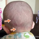 赤ちゃんの後頭部に乳児湿疹？ではなくウンナ母斑かも！