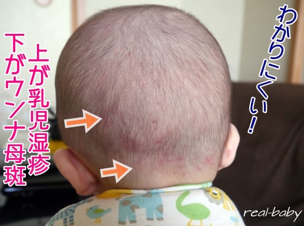 赤ちゃんの後頭部に乳児湿疹？ではなくウンナ母斑かも！