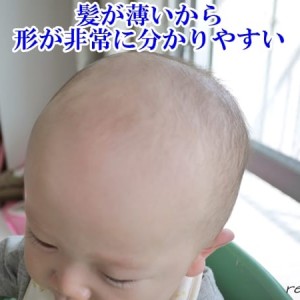赤ちゃんの頭の形はいつまでにどんなことをすると治せるの？