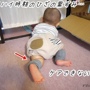 ハイハイ赤ちゃんの膝に黒ずみが！ケア方法＆これって対処が必要なの？