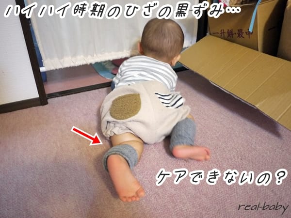 ハイハイ赤ちゃんの膝に黒ずみが！ケア方法＆これって対処が必要なの？